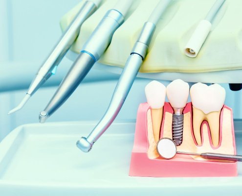 Implantologia a Carico Immediato