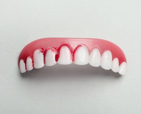 Sanguinamento Gengivale