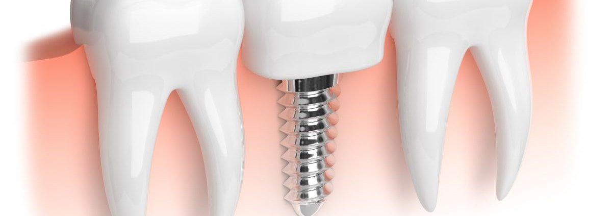 Impianto Dentale Fallito