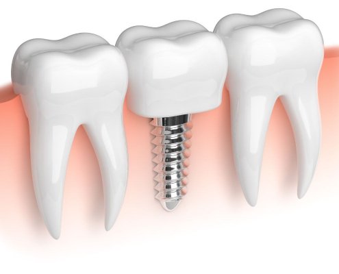 Impianto Dentale Fallito