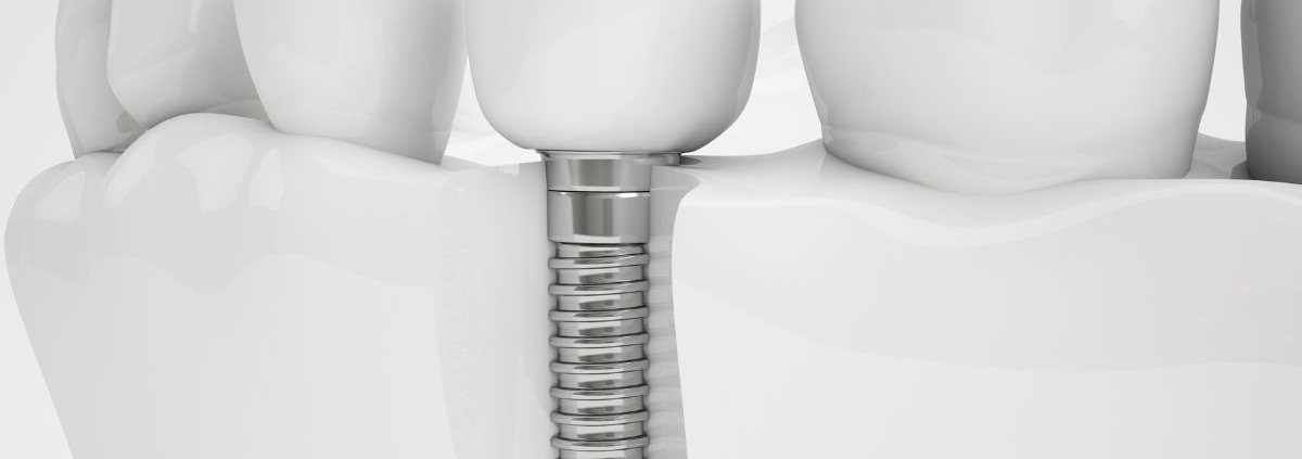 Quando Sostituire Impianto Dentale