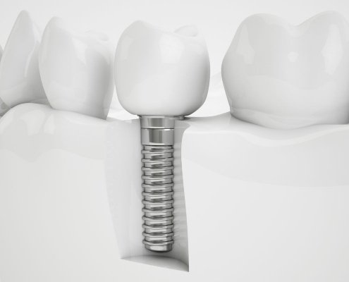 Quando Sostituire Impianto Dentale
