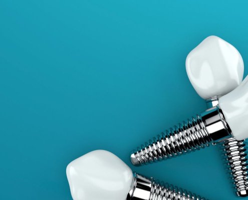 Impianti All on Four