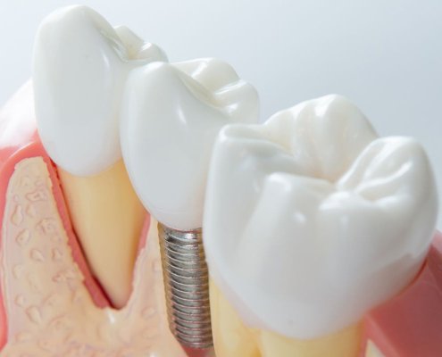 Impianto dentale a carico immediato
