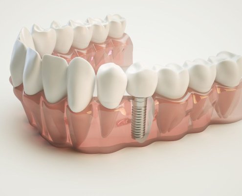 Impianto a carico immediato