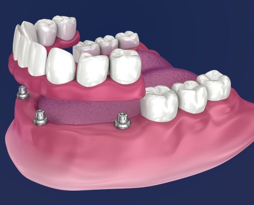 Impianti All On 4