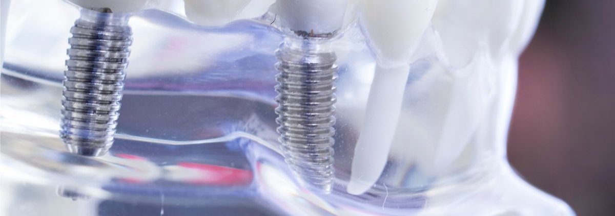 Impianti dentali carico immediato
