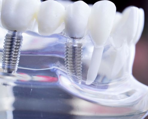 Impianti dentali carico immediato