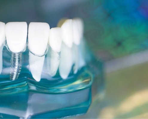 Implantologia Carico Immediato