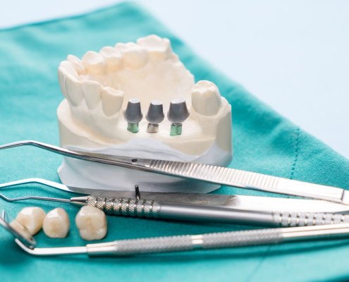 impianto dentale carico immediato