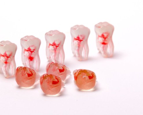 Trattamento Endodontico