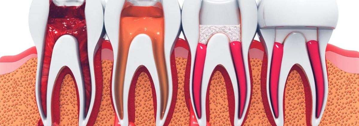Endodonzia Odontoiatria