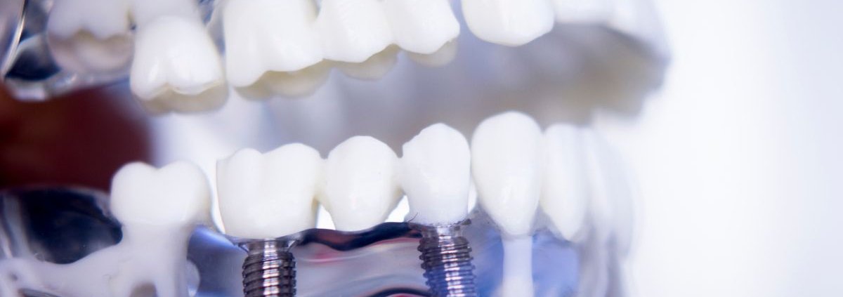 Impianto dentale Roma e Velletri