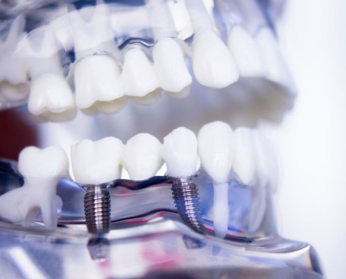 Impianto dentale Roma e Velletri