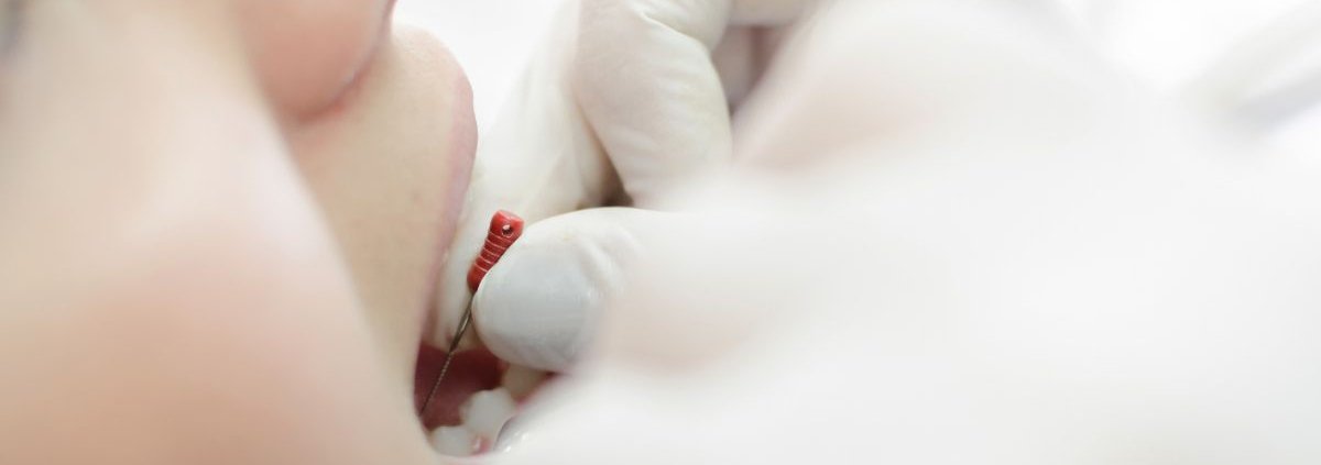 Devitalizzazione dente