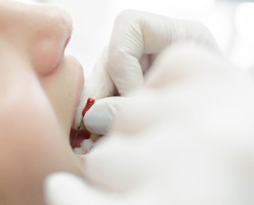 Devitalizzazione dente