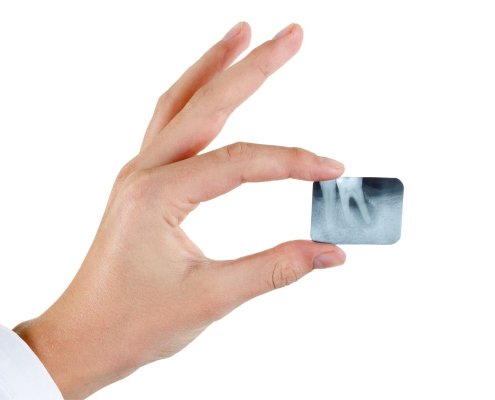 Parodontite Aggressiva