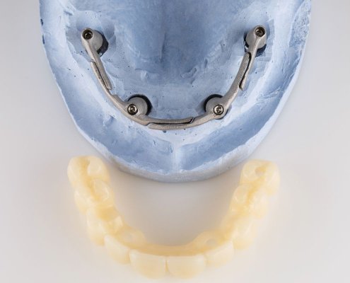 Implantologia Carico Immediato