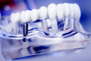 Implantologia dentale