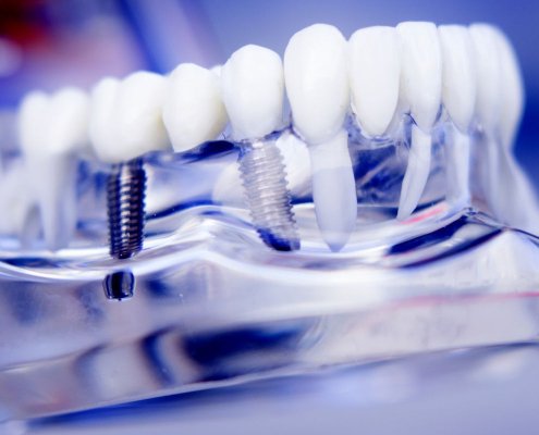 Implantologia dentale