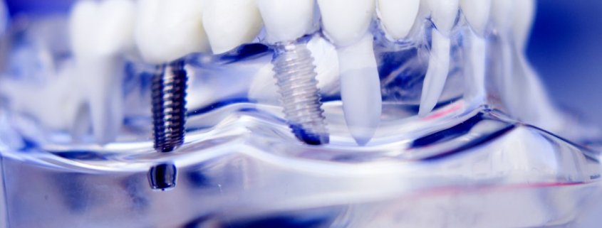 Implantologia dentale