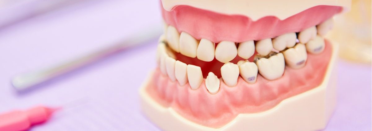Malocclusione_bambini