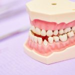Malocclusione_bambini