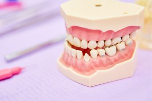 Malocclusione_bambini