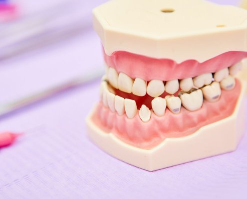 Malocclusione_bambini