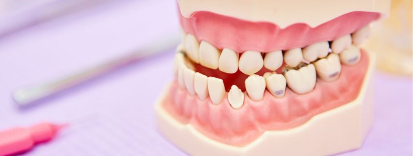Malocclusione_bambini