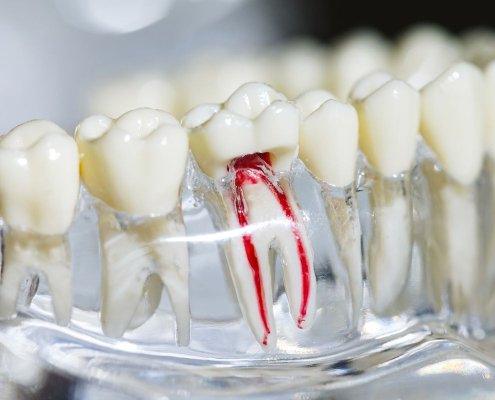 Trattamento Canalare