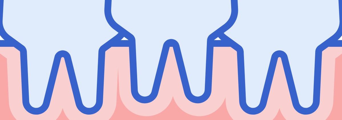 Affollamento Dentale