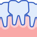 Affollamento Dentale