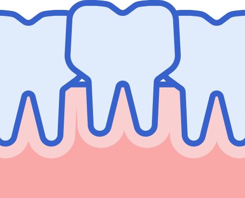 Affollamento Dentale