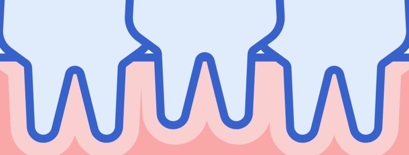 Affollamento Dentale