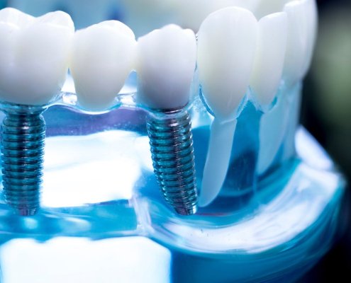 Implantologia soluzioni con poco osso