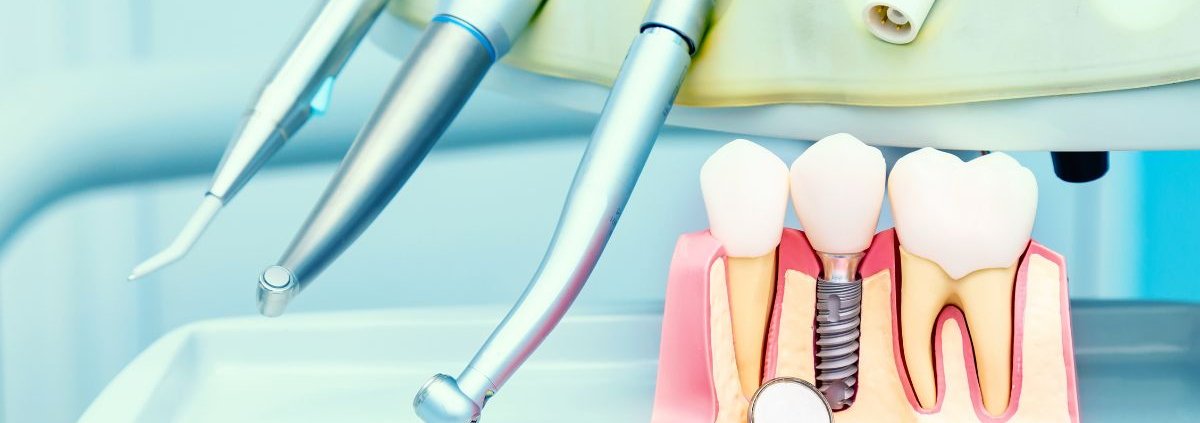 Intervento Implantologia Dentale