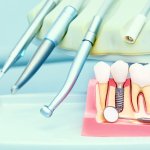 Intervento Implantologia Dentale