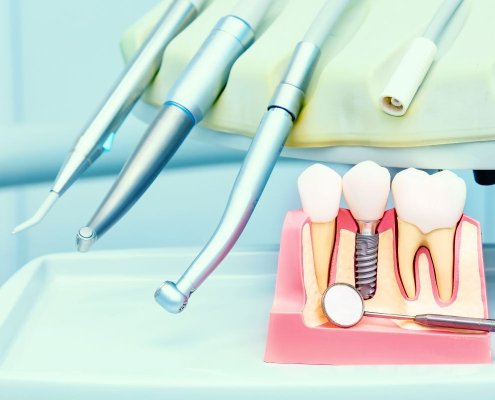 Intervento Implantologia Dentale