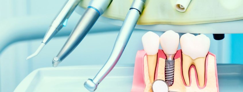 Intervento Implantologia Dentale