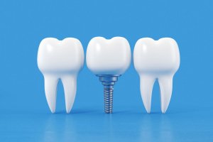 Impianto Dentale