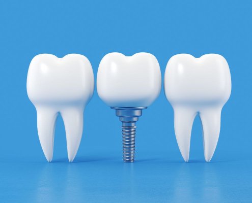 Impianto Dentale