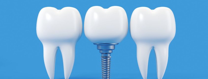 Impianto Dentale