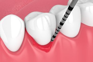 Parodontite come curarla