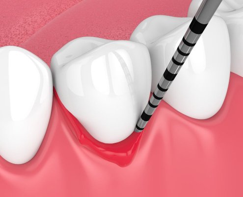 Parodontite come curarla