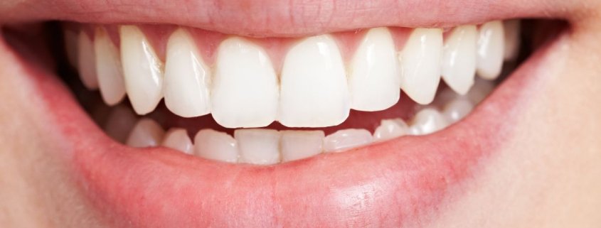 Come rimuovere macchie dai denti