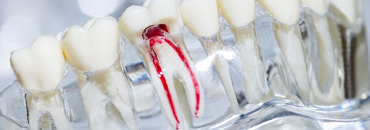 Devitalizzazione dente