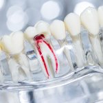 Devitalizzazione dente