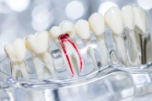 Devitalizzazione dente