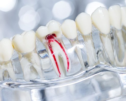 Devitalizzazione dente
